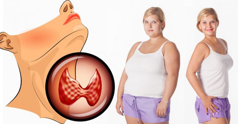 What Is Hypothyroidism And How To Lose Weight In This Disease Diet