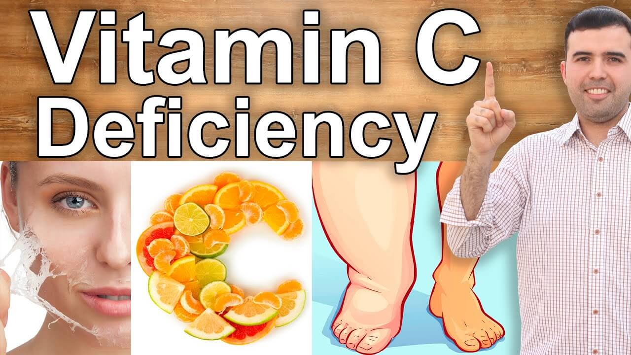 Deficiența De Vitamina C Hipovitaminoza Cauze Simptome Tratament | The ...