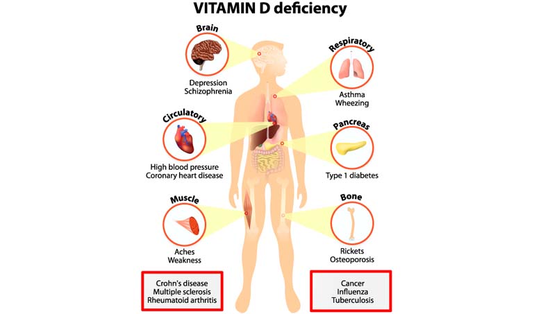 Vitamin D Deficiency1