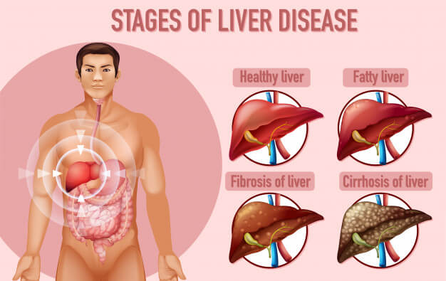 Stages of Liver Cirrhosis