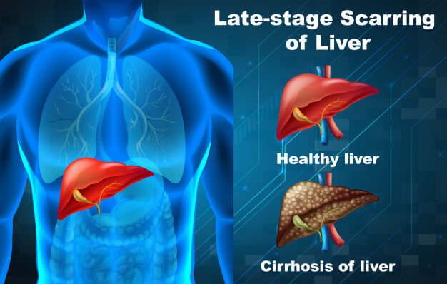 What Is Liver Cirrhosis